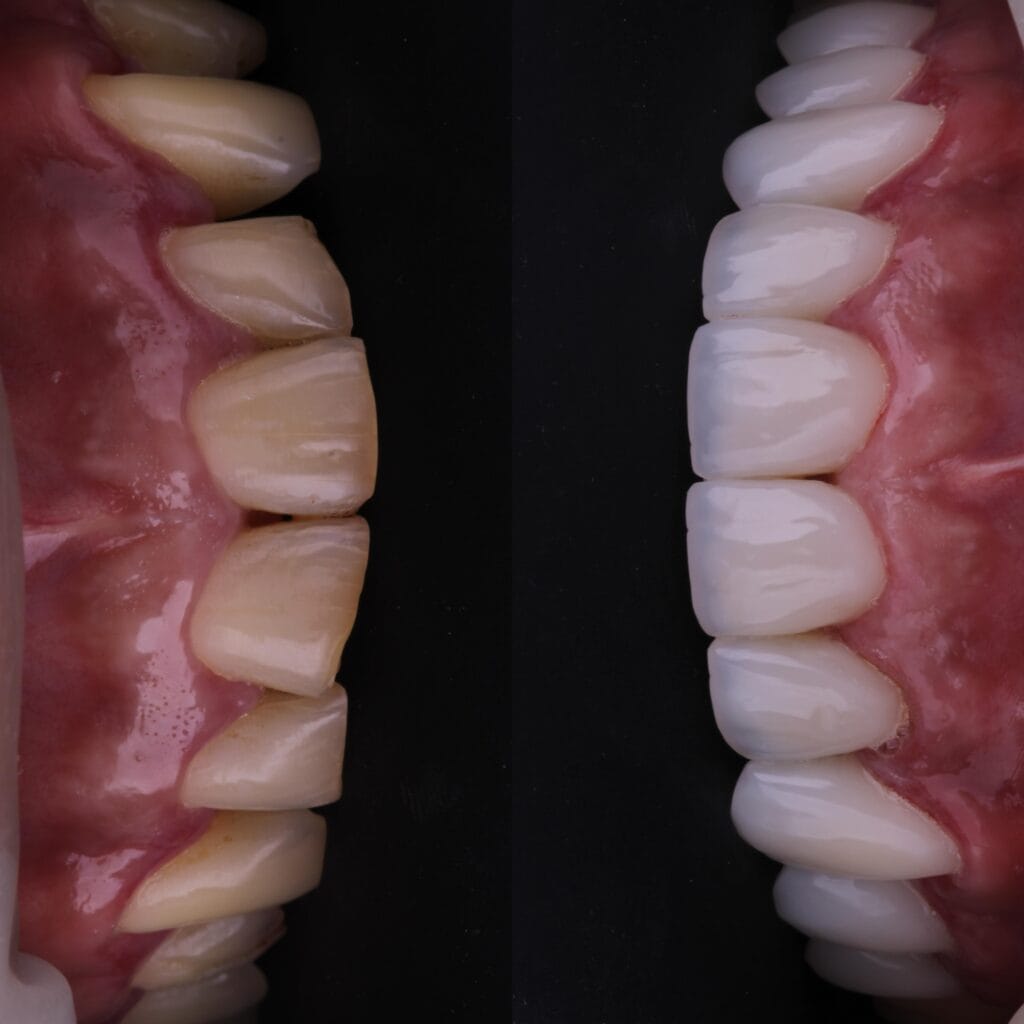 FACETA DE PORCELANA E RESINA