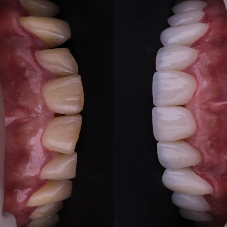 FACETA DE PORCELANA E RESINA