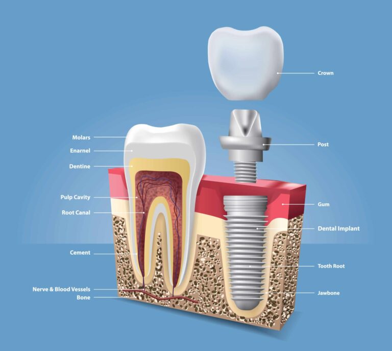 Qual a diferença entre implante e coroa