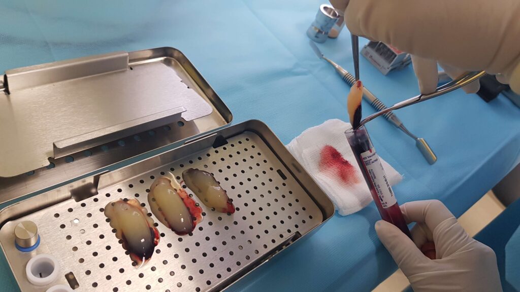 Indicações do PRF na Odontologia